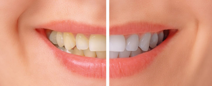 دندان بدون جرم